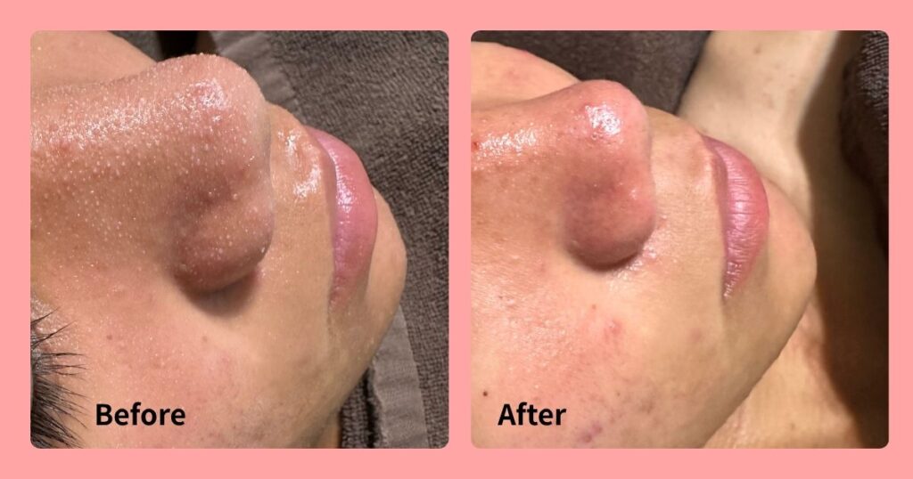 🌿季節の変わり目こそ毛穴ケア！つるんと肌に🫧