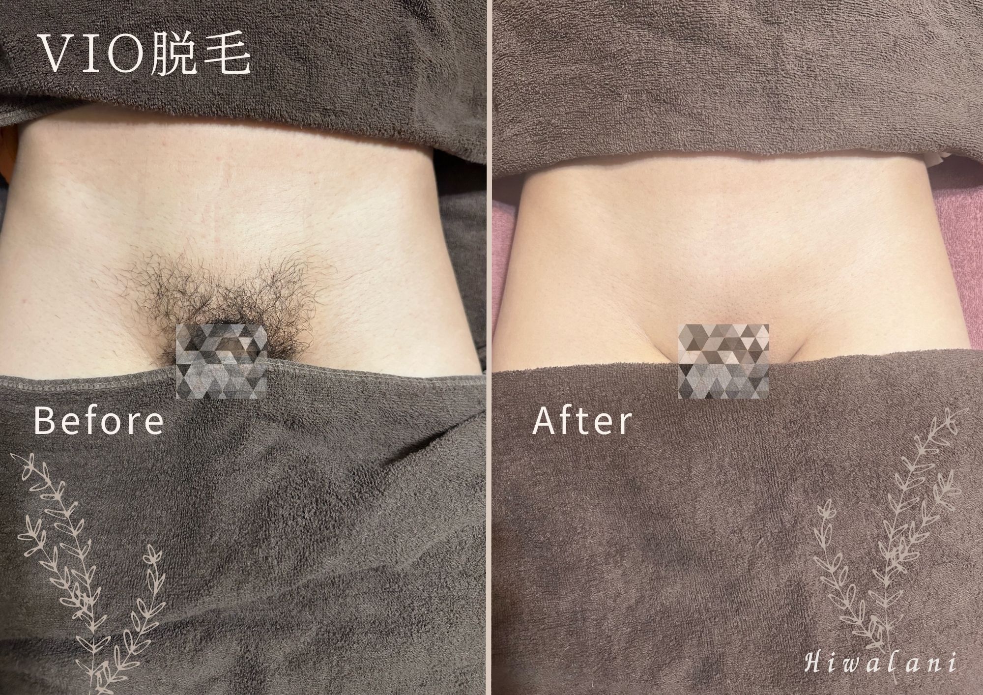 VIO脱毛｜施術例